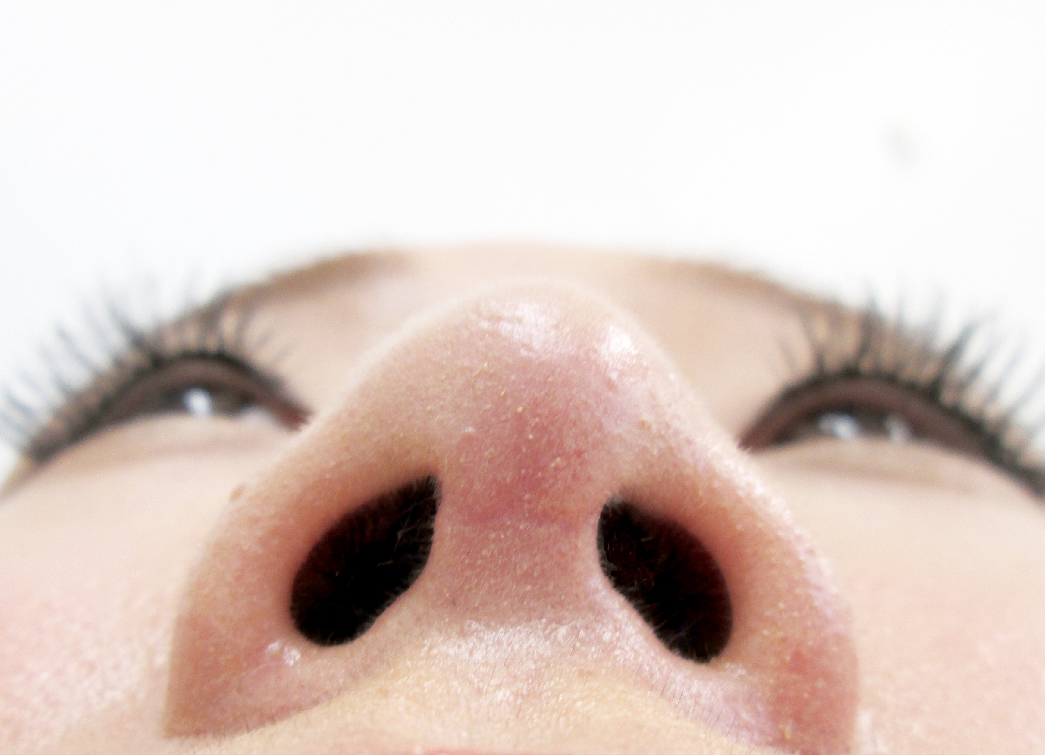 鼻プロテーゼ・鼻中隔延長施術後下から写真