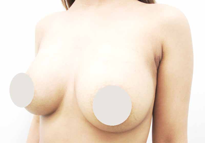 Breast augmentation_20151203_200cc術後１ヶ月目_1