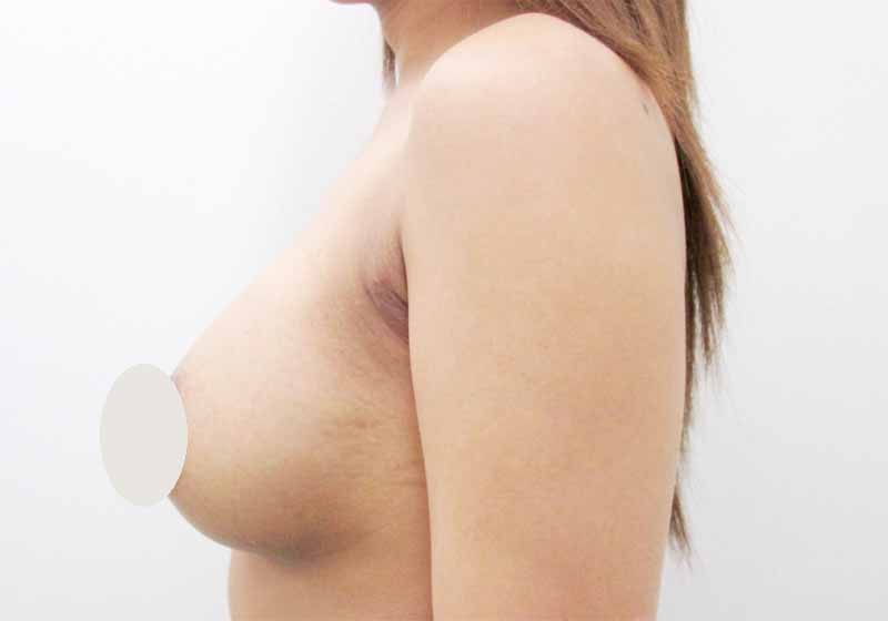 Breast augmentation_20151203_200cc術後１ヶ月目_2