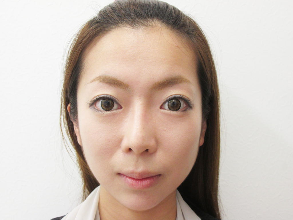 16年1月31日 顎のプロテーゼ 鼻のプロテーゼ 鼻尖縮小 耳介軟骨移植 症例写真 美容整形 美容外科なら水の森美容外科 公式 総合サイト 16年1月31日 顎のプロテーゼ 鼻のプロテーゼ 鼻尖縮小 耳介軟骨移植 症例写真 美容整形 美容外科なら水の森美容外科 公式 総合サイト