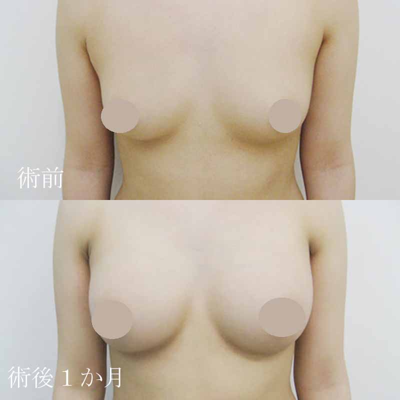 Breast augmentation_1_takee_20160520
