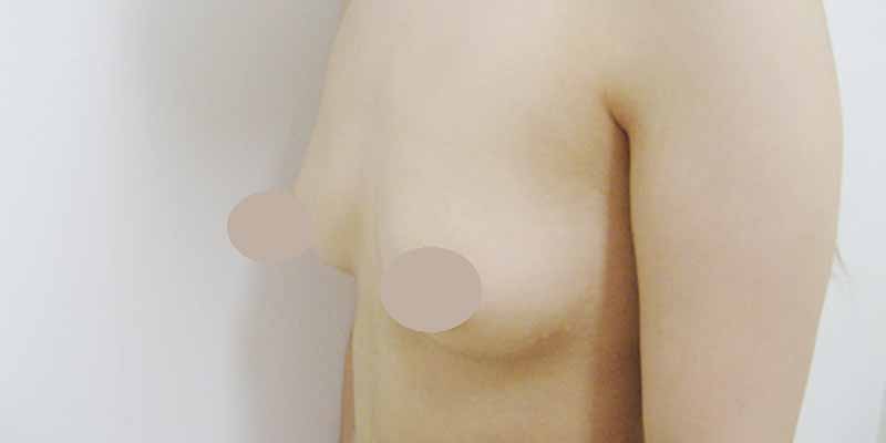 Breast augmentation_2_takee_20160520