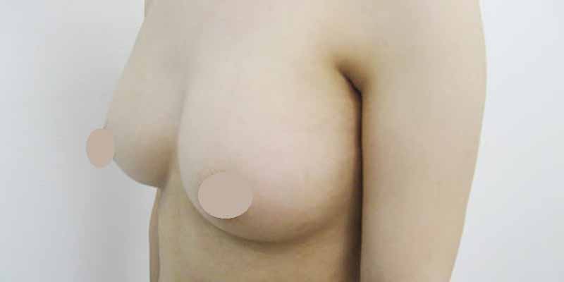 Breast augmentation_3_takee_20160520