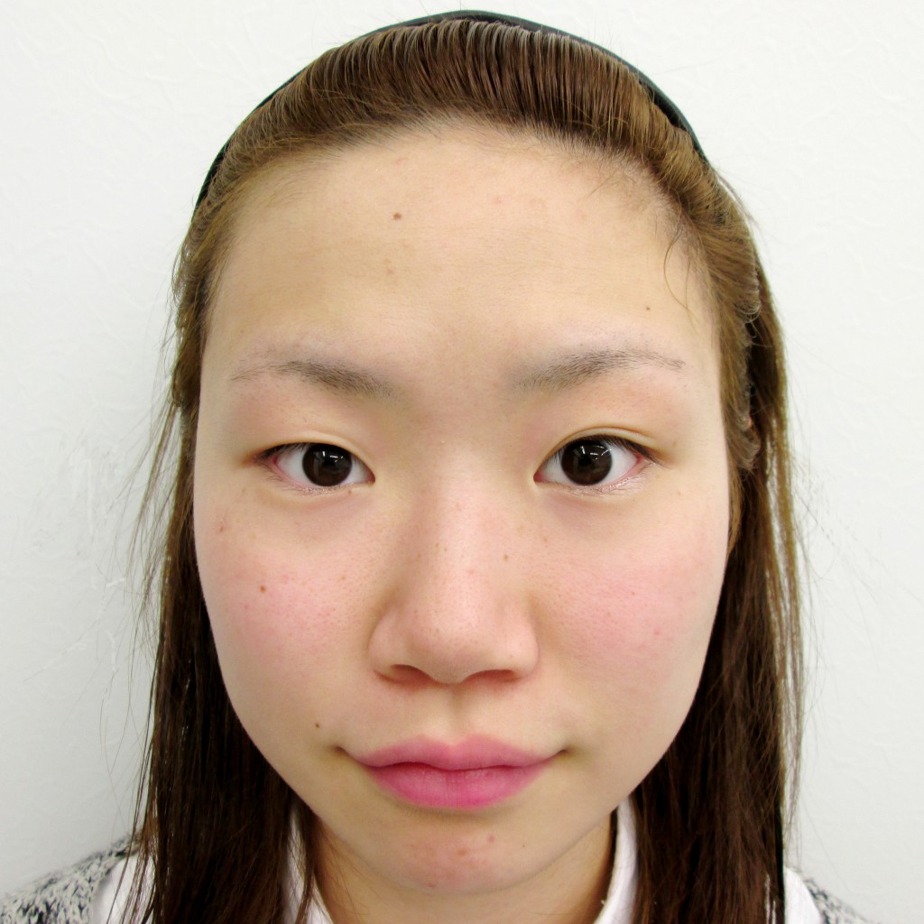 16年5月15日 鼻プロテーゼ 二重埋没法 右目 症例写真 美容整形 美容外科なら水の森美容外科 公式 総合サイト 16年5月15日 鼻プロテーゼ 二重埋没法 右目 症例写真 美容整形 美容外科なら水の森美容外科 公式 総合サイト