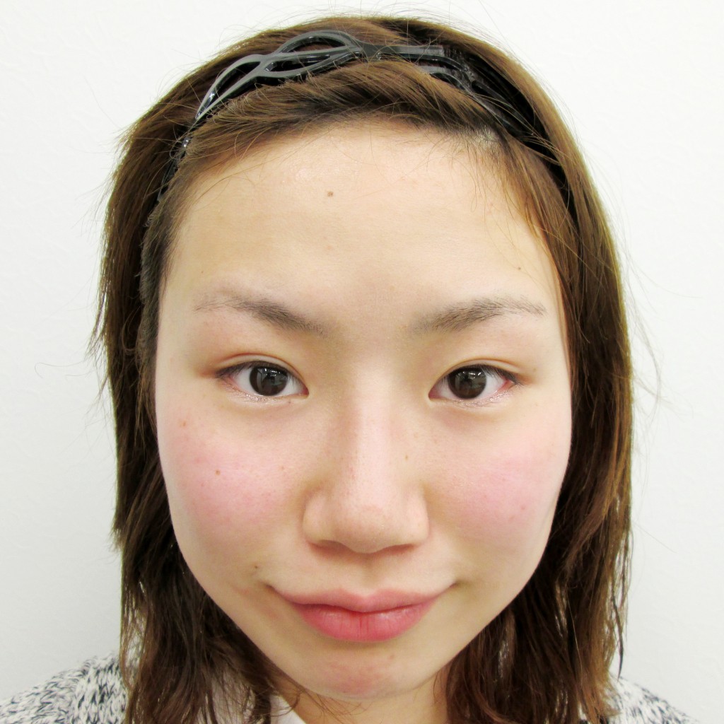 16年5月15日 鼻プロテーゼ 二重埋没法 右目 症例写真 美容整形 美容外科なら水の森美容外科 公式 総合サイト 16年5月15日 鼻プロテーゼ 二重埋没法 右目 症例写真 美容整形 美容外科なら水の森美容外科 公式 総合サイト