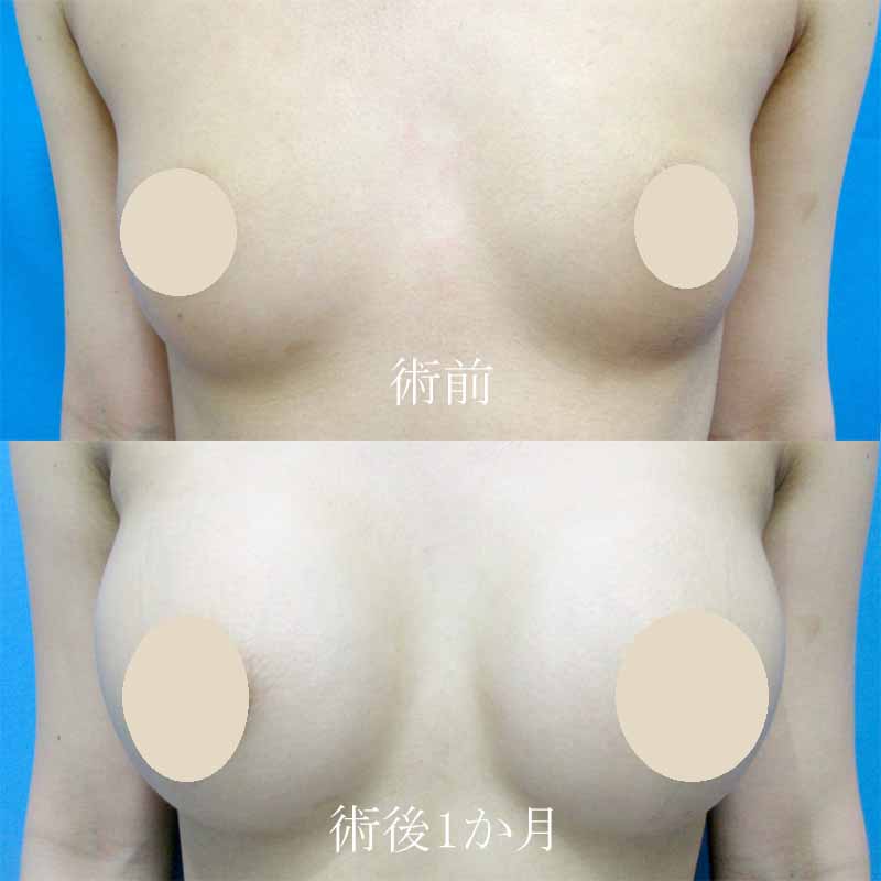 Breast augmentation_20160701MM
