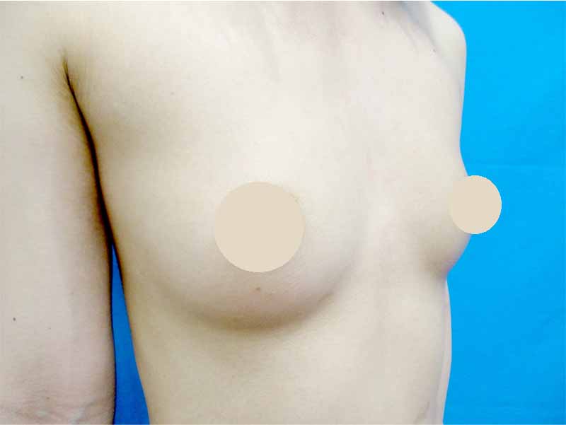 Breast augmentation_20160701施術前_1