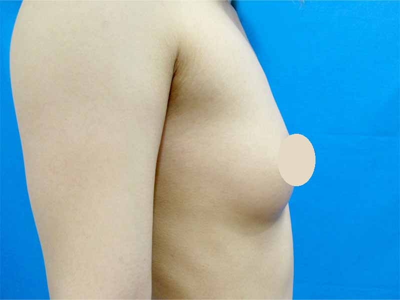 Breast augmentation_20160701施術前_2