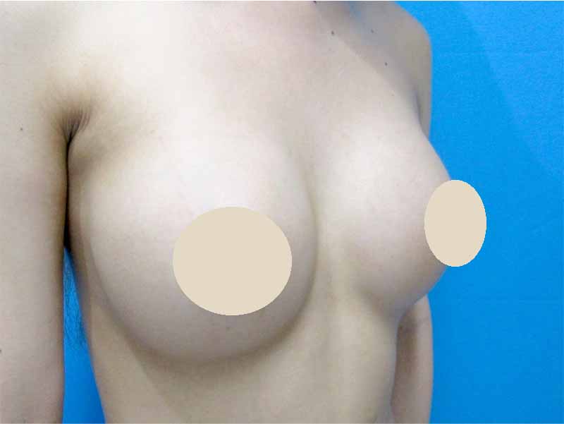 Breast augmentation_20160701術後１ヶ月目_1