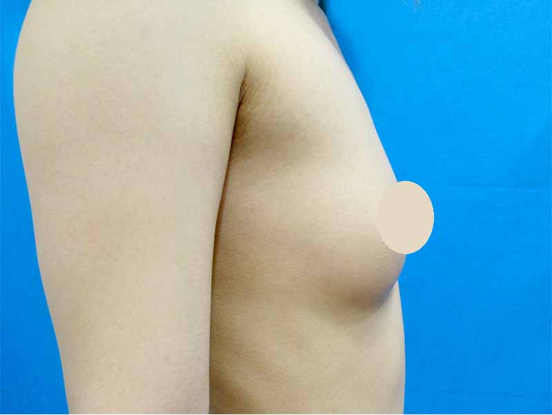 Breast augmentation_20160701術後１ヶ月目_2