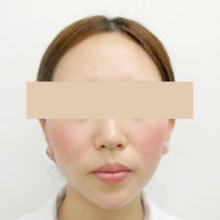 顎のヒアルロン酸注入 注入認定医が在籍 美容整形 美容外科なら水の森美容外科 公式 総合サイト