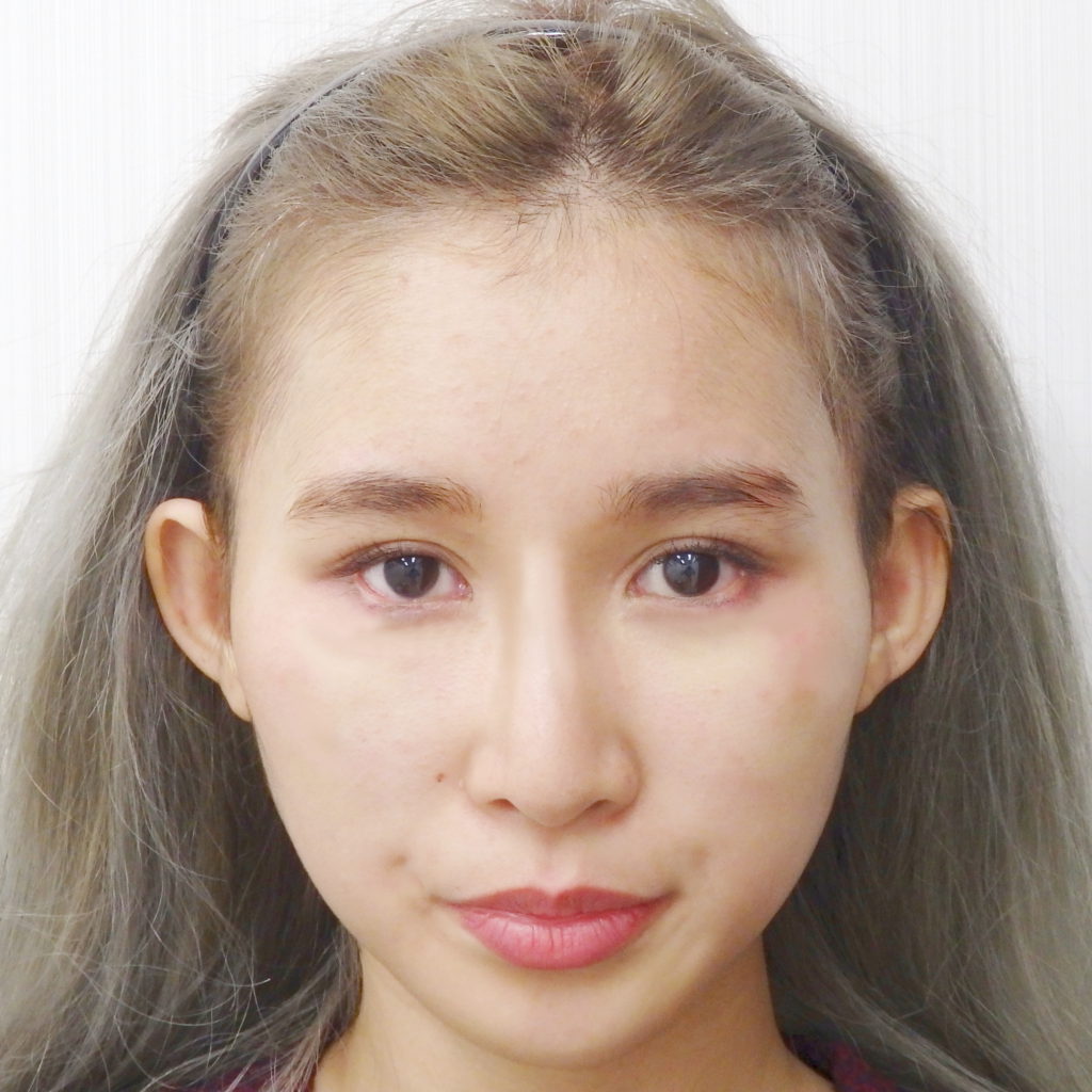 16年12月6日 鼻のプロテーゼ 症例写真 美容整形 美容外科なら水の森美容外科 公式 総合サイト 16年12月6日 鼻のプロテーゼ 症例写真 美容整形 美容外科なら水の森美容外科 公式 総合サイト