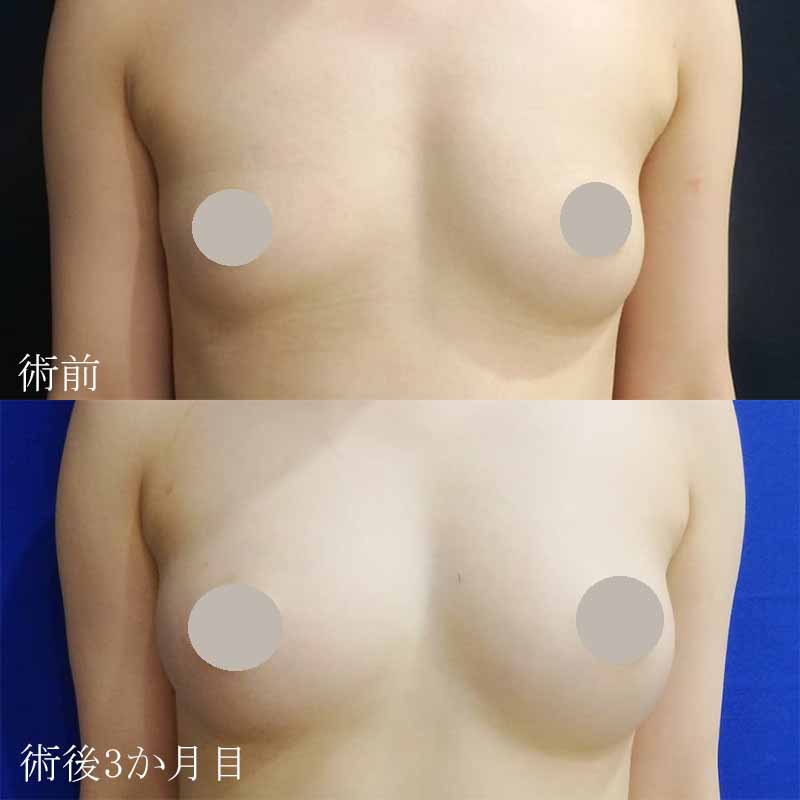 Breast augmentation_1_takee_20170120