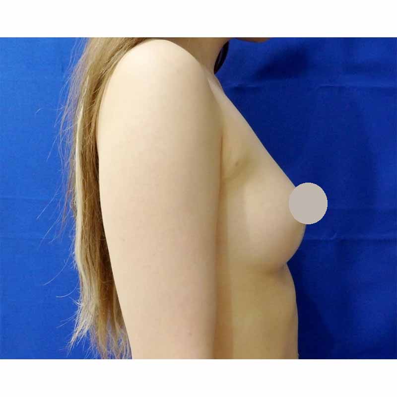 Breast augmentation_5_takee_20170120