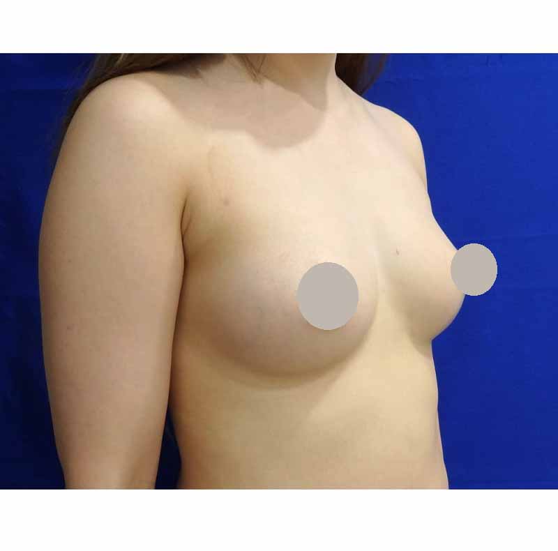 Breast augmentation_3_takee_20170120