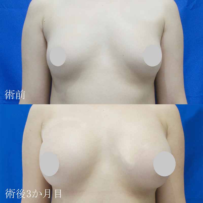 Breast augmentation_20170523MM