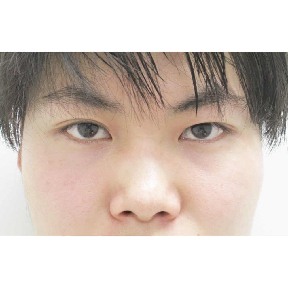鼻のプロテーゼ施術前正面アップ写真