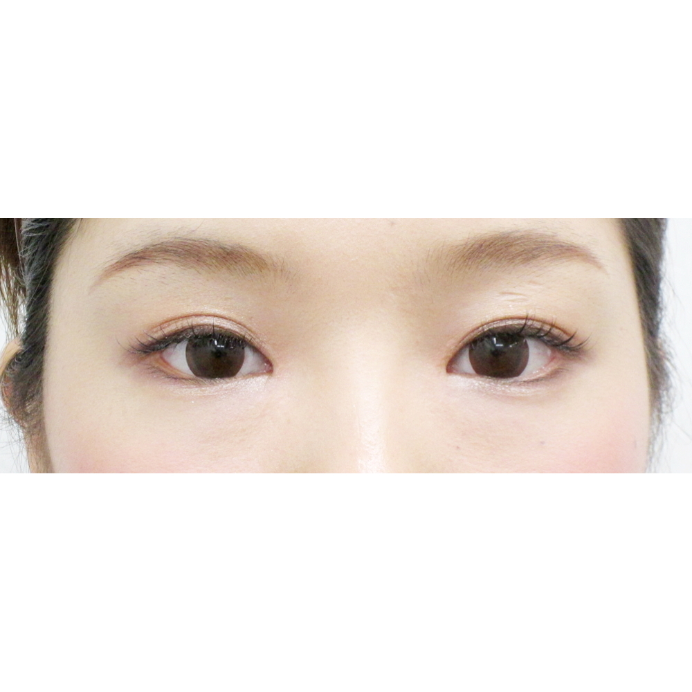 たれ目のボトックス注射 水の森美容外科 総合サイト 美容整形 美容外科クリニック たれ目のボトックス注射 水の森美容外科 総合サイト 美容整形 美容外科クリニック