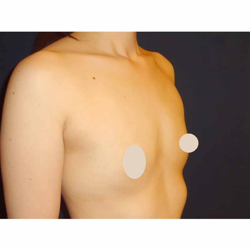 Breast augmentation_1_takee_20170928