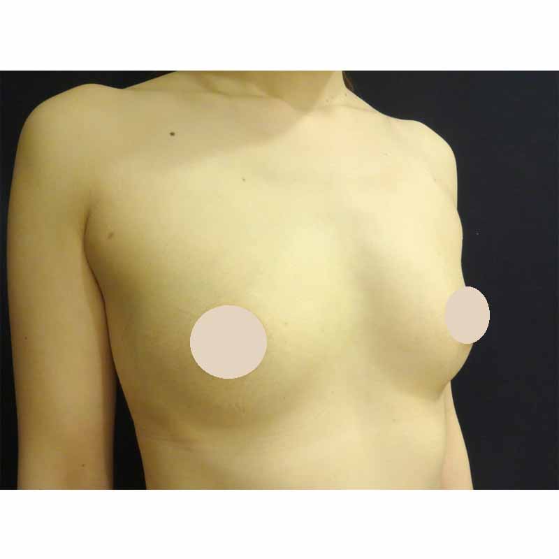 Breast augmentation_2_takee_20170928