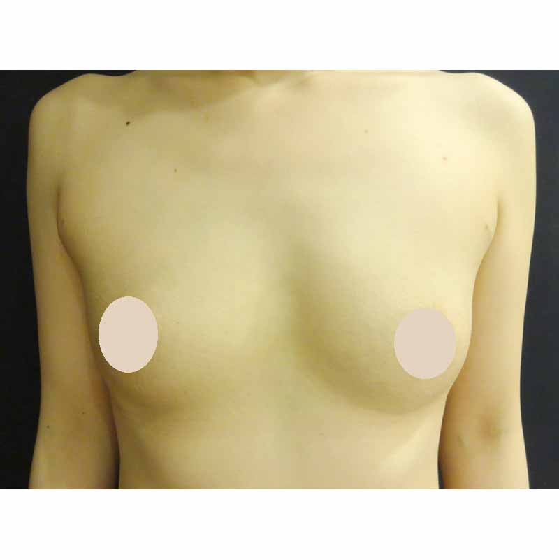 Breast augmentation_4_takee_20170928