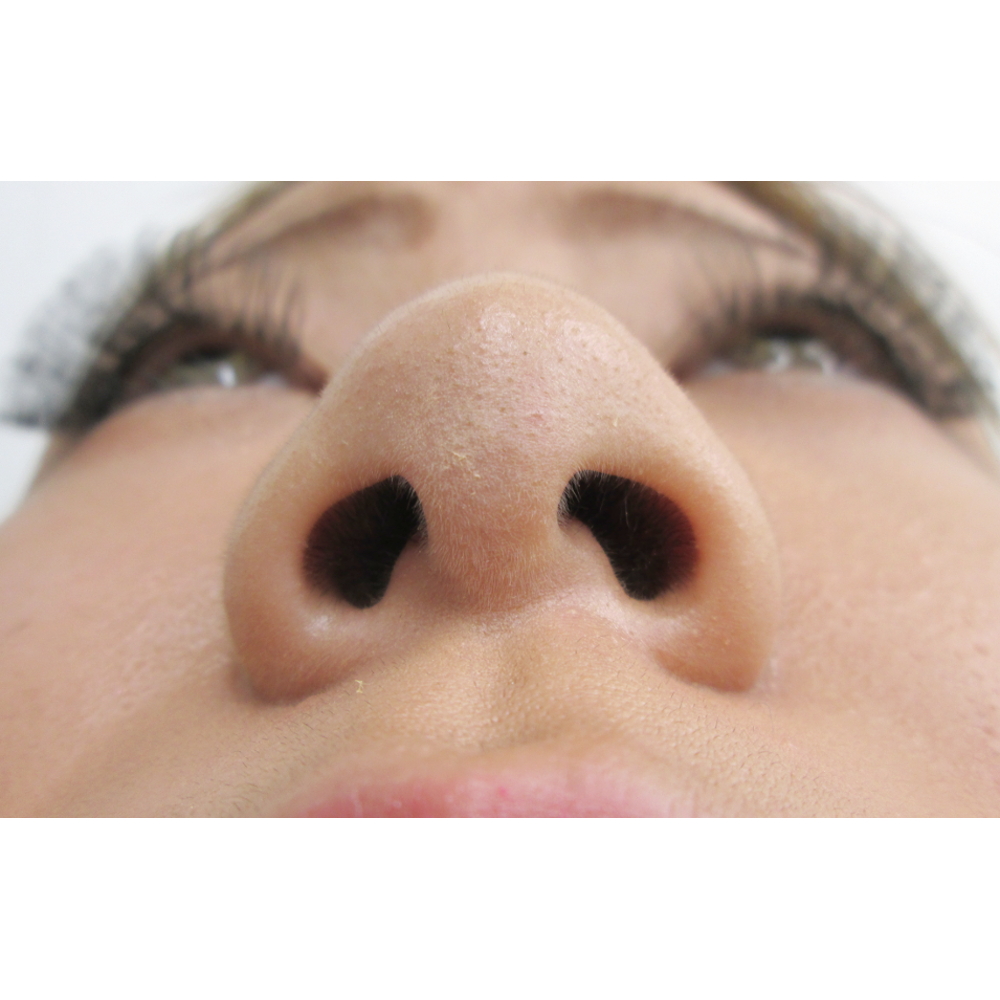 鼻のプロテーゼ挿入・鼻尖縮小・耳介軟骨移植施術前下からの写真