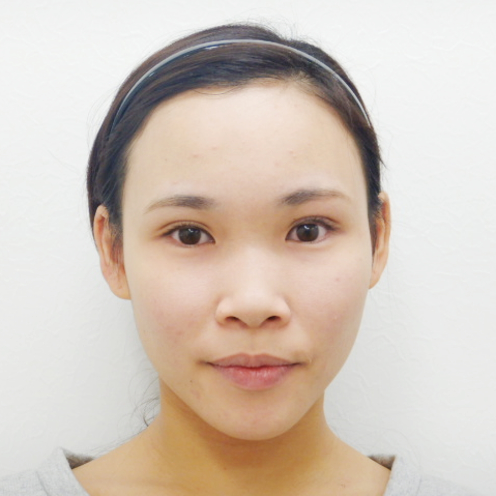 18年3月日 鼻プロテーゼ 鼻尖縮小 耳介軟骨移植 症例写真 美容整形 美容外科なら水の森美容外科 公式 総合サイト 18年3月日 鼻プロテーゼ 鼻尖縮小 耳介軟骨移植 症例写真 美容整形 美容外科なら水の森美容外科 公式 総合サイト