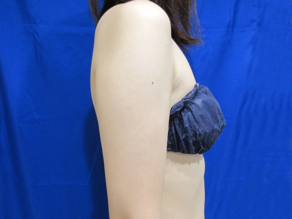 【脂肪吸引】二の腕全周（振袖・肩の張り出し+ひじ上+つけ根・背中）術前