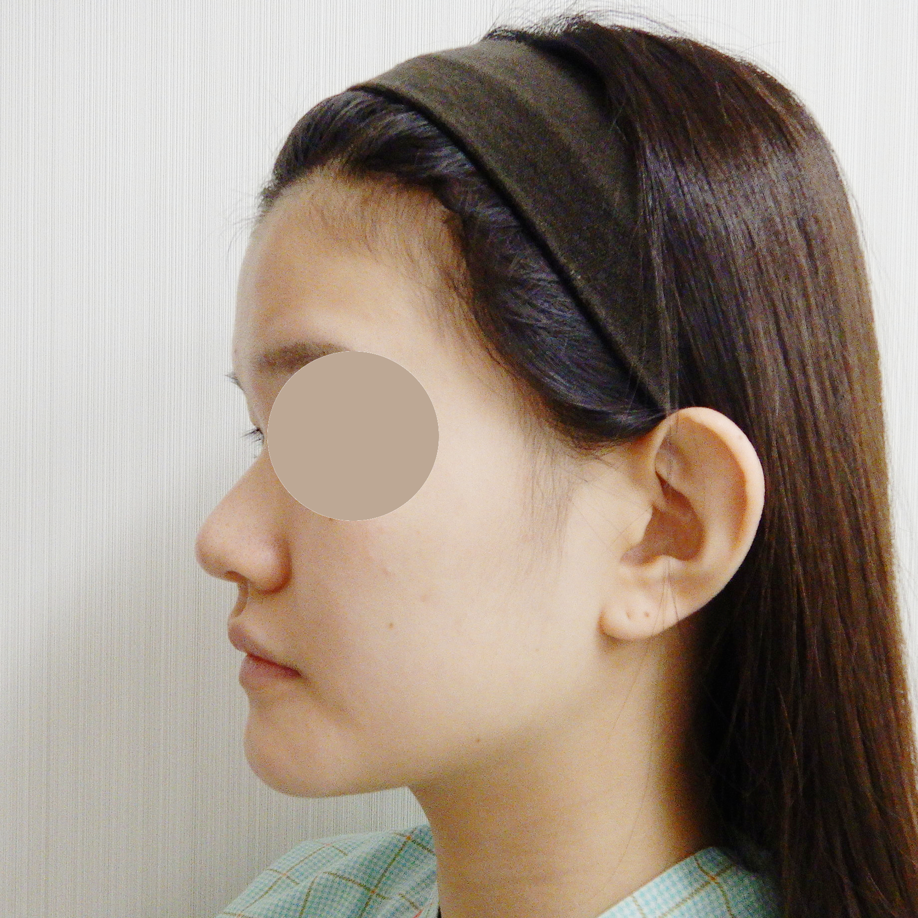 鼻のプロテーゼ・鼻尖縮小・耳介軟骨移植術前横からの写真