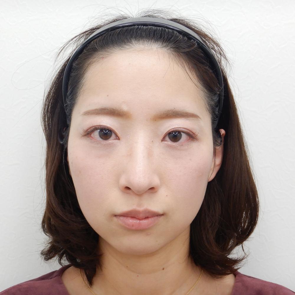 二重埋没法 目の上のヒアルロン酸注入 水の森美容外科 総合サイト 美容整形 美容外科クリニック