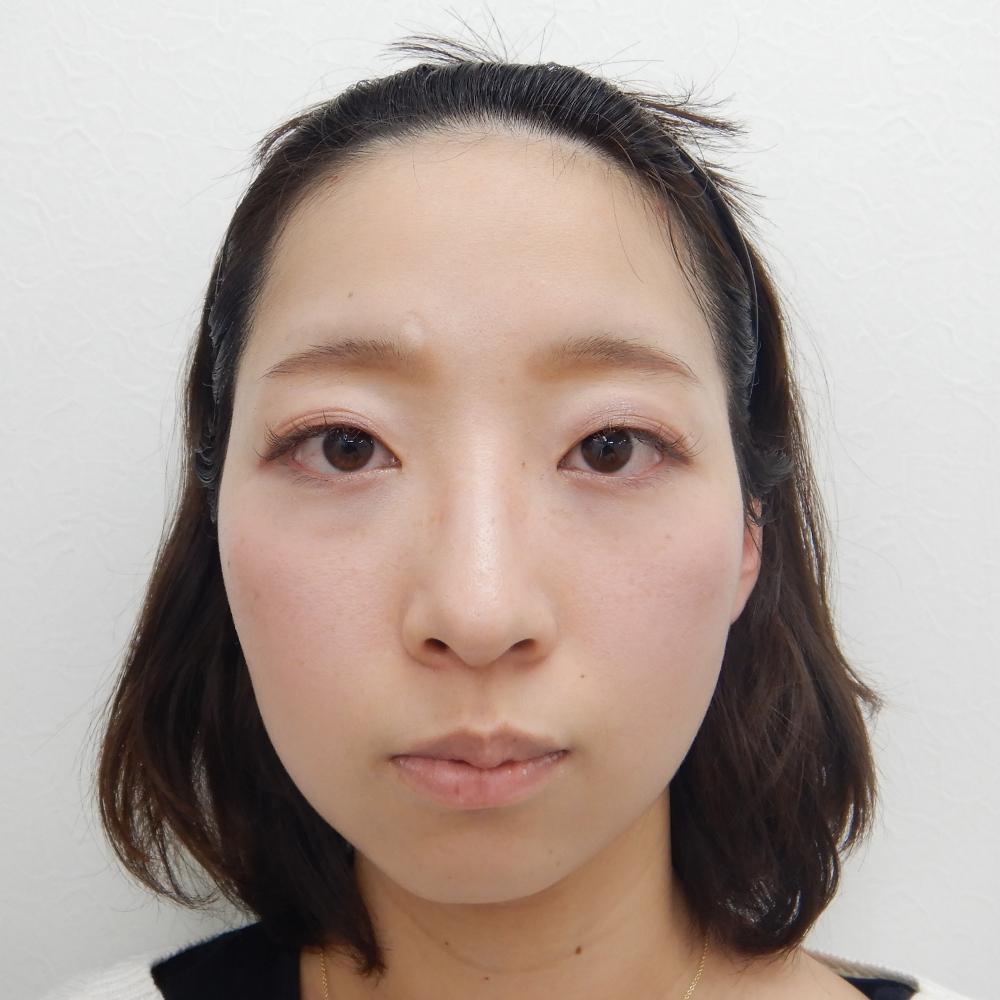 二重埋没法 目の上のヒアルロン酸注入 水の森美容外科 総合サイト 美容整形 美容外科クリニック