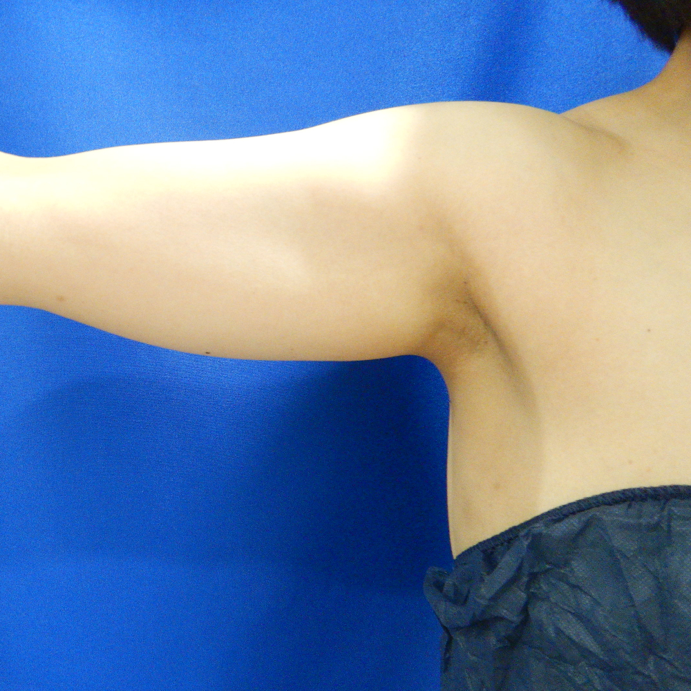 【脂肪吸引】二の腕全周(振袖・肩張り出し+背中+つけ根+ひじ上)術前