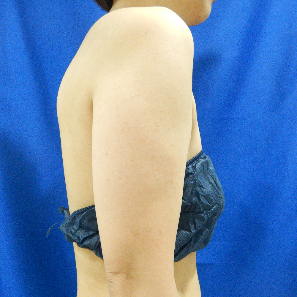 【脂肪吸引】二の腕全周(振袖・肩張り出し+背中+つけ根+ひじ上)術前
