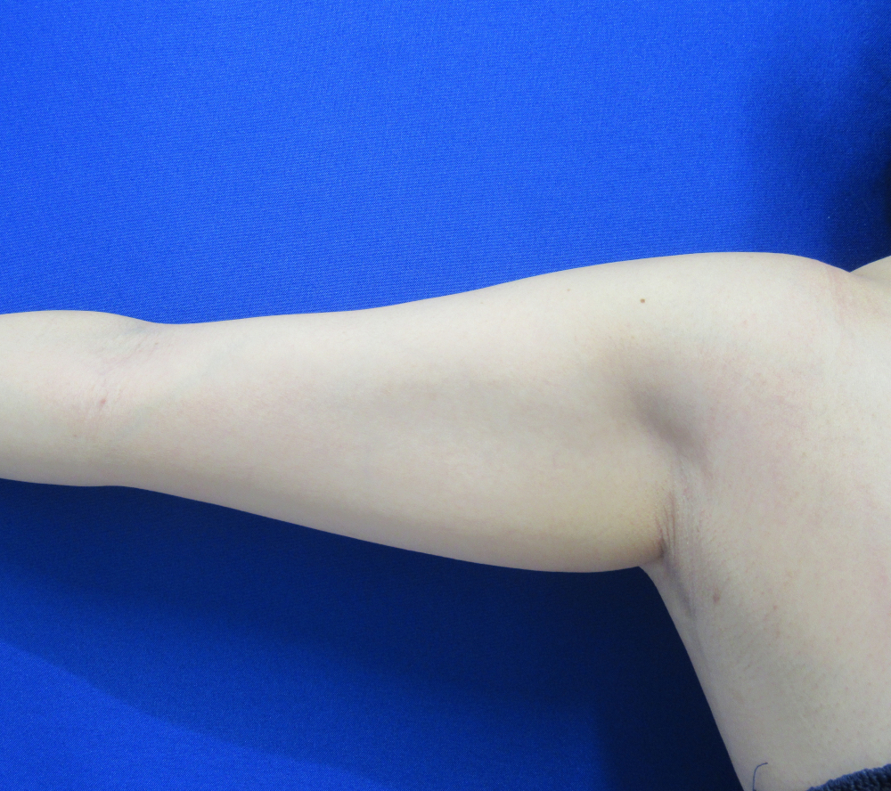 脂肪吸引 二の腕全周 振袖 肩張り出し 背中 つけ根 ひじ上 水の森美容外科 総合サイト 美容整形 美容外科クリニック