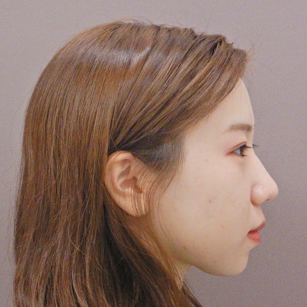 額のヒアルロン酸注入の症例写真 費用 リスク 副作用 水の森美容外科 総合サイト 美容整形 美容外科クリニック