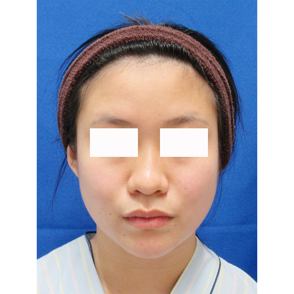 頬・顎の脂肪吸引エラのボトックス術前の症例写真