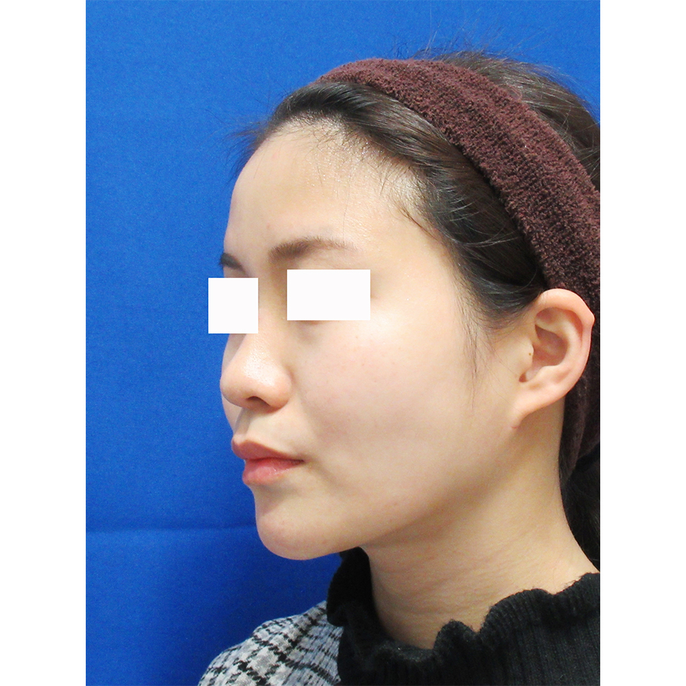 頬・顎の脂肪吸引術後の症例写真