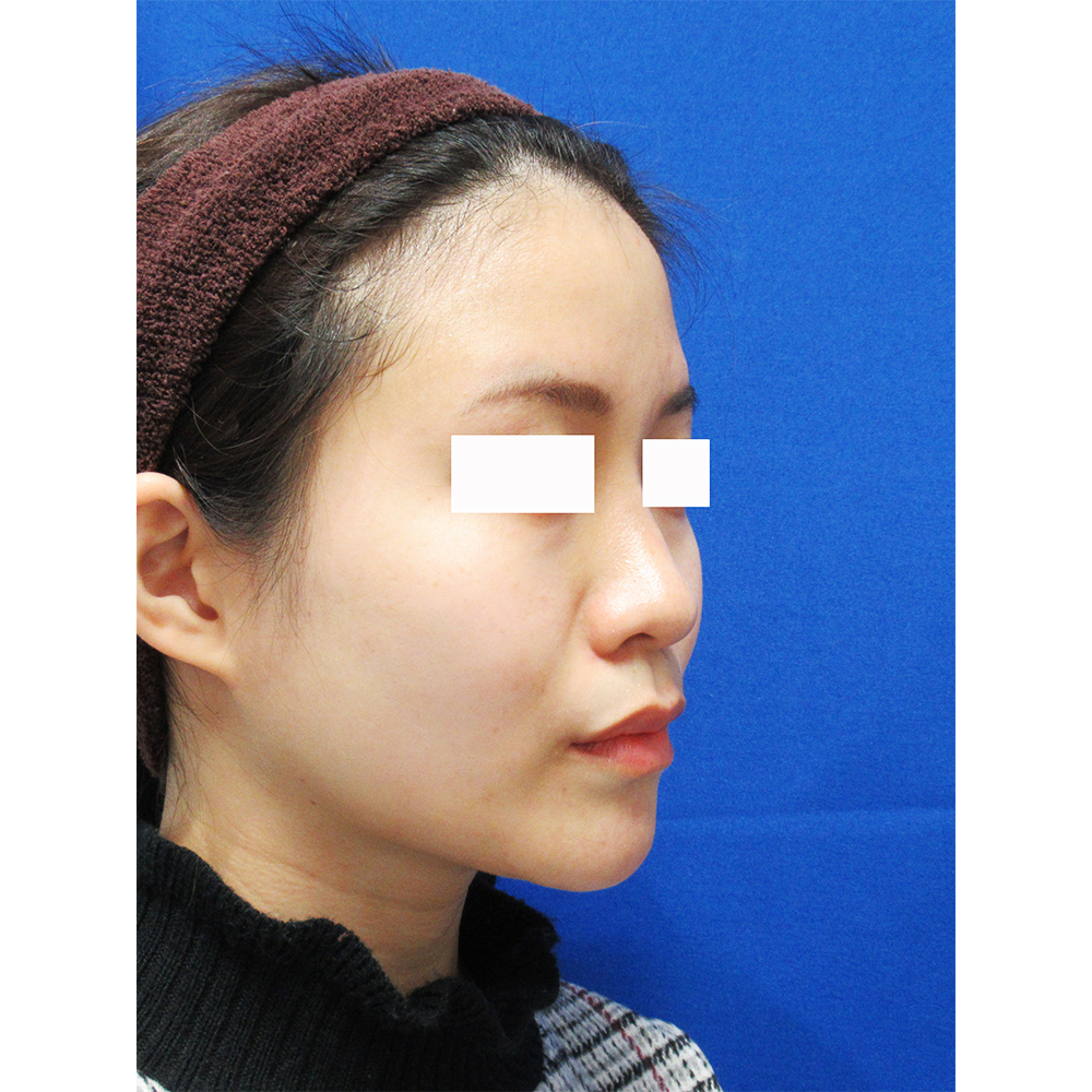 頬・顎の脂肪吸引とエラのボトックス術後の症例写真