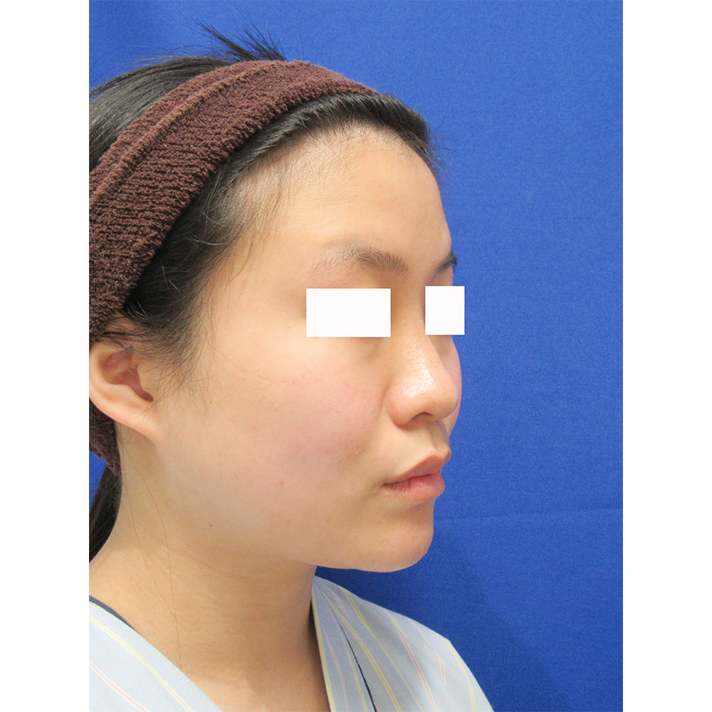 頬・顎の脂肪吸引とエラのボトックス術前の症例写真