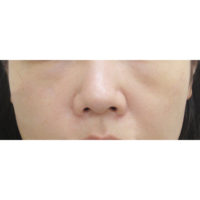 鼻尖耳介術前の症例写真