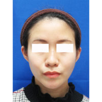 頬 顎など顔の脂肪吸引について 美容整形 美容外科なら水の森美容外科 公式 総合サイト 頬 顎など顔の脂肪吸引について 美容整形 美容外科なら水の森美容外科 公式 総合サイト