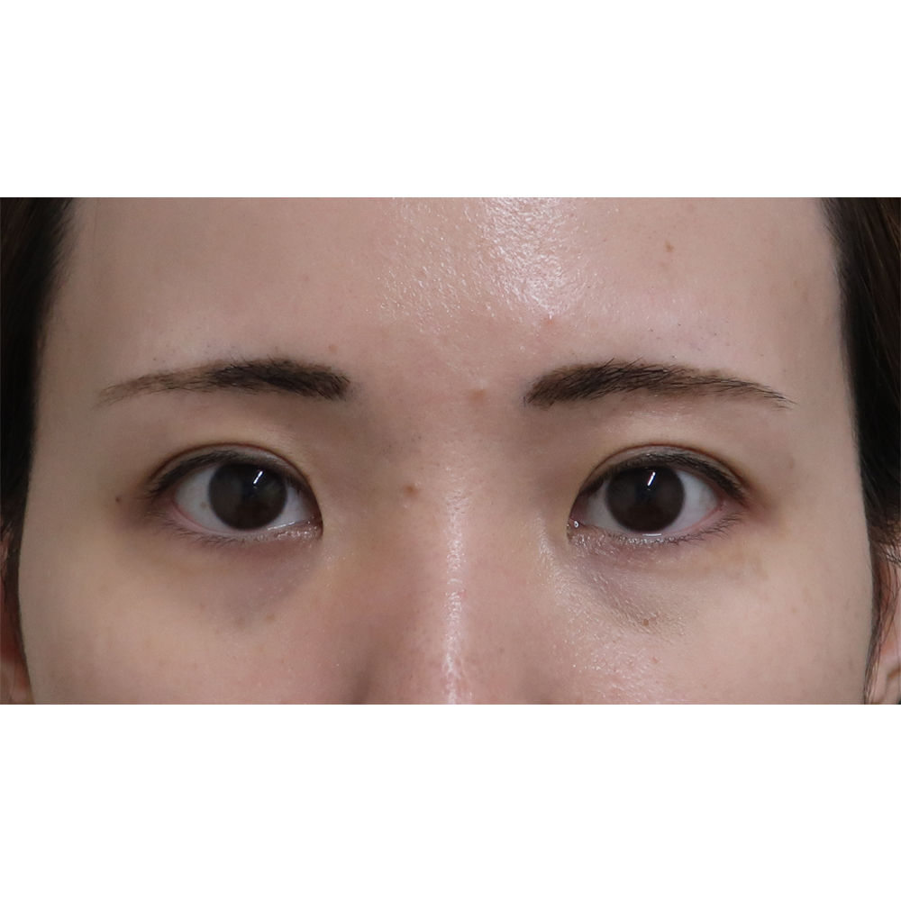 二重切開法施術3か月後症例写真