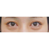 目頭切開法 目元 二重の整形 について 美容整形 美容外科なら水の森美容外科 公式 総合サイト 目頭切開法 目元 二重の整形 について 美容整形 美容外科なら水の森美容外科 公式 総合サイト