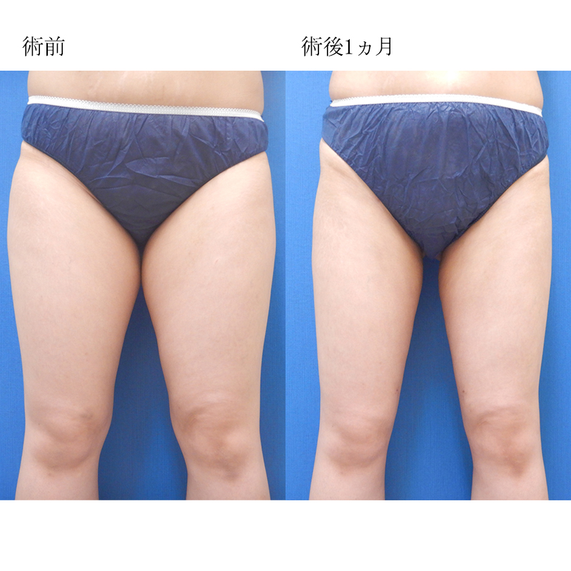 脂肪吸引太もも全周（臀部含む）_2021.09.07_西川陽平