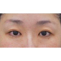 目頭切開法 目元 二重の整形 について 美容整形 美容外科なら水の森美容外科 公式 総合サイト 目頭切開法 目元 二重の整形 について 美容整形 美容外科なら水の森美容外科 公式 総合サイト