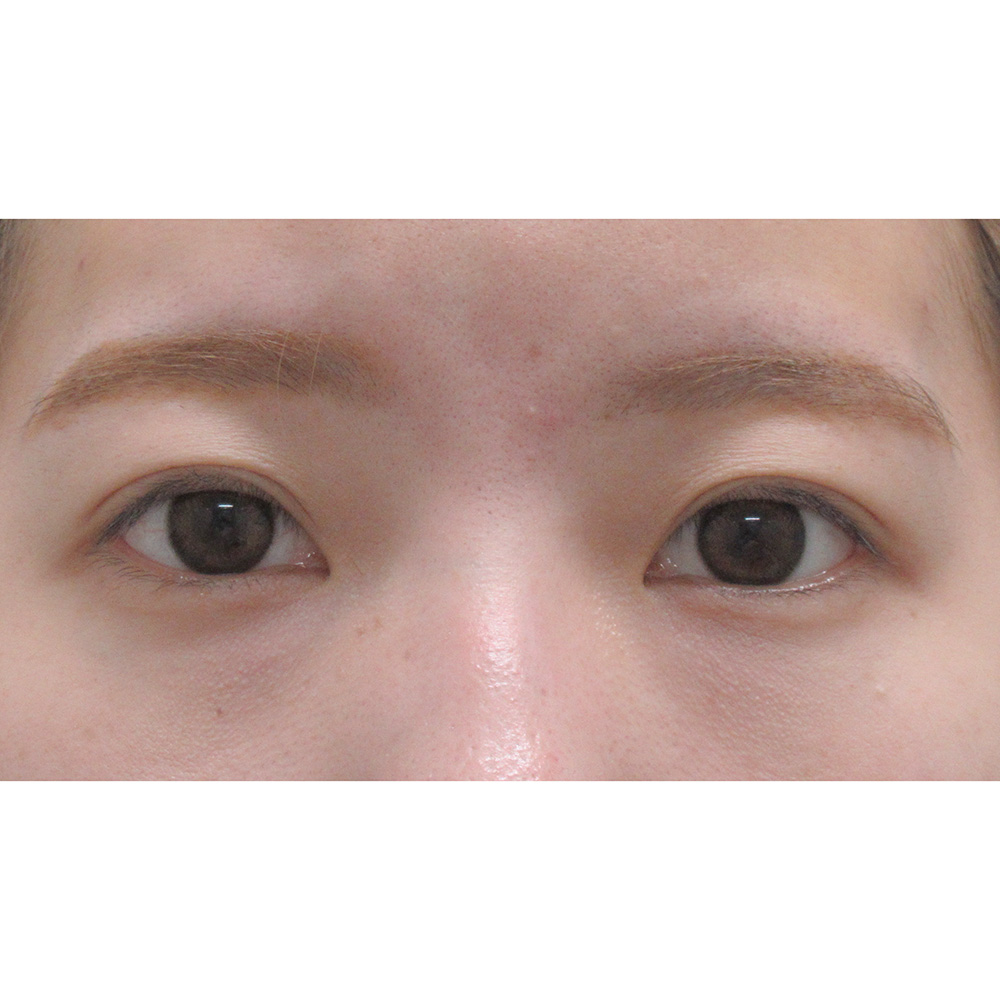 涙袋のヒアルロン酸注入の症例写真 費用 リスク 副作用 美容整形なら水の森美容外科