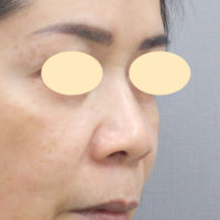 鼻尖縮小 だんご鼻 団子鼻修正 の整形について 美容整形 美容外科なら水の森美容外科 公式 総合サイト