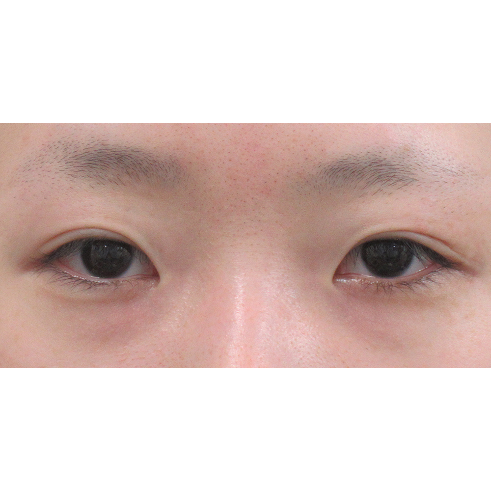 施術前正面