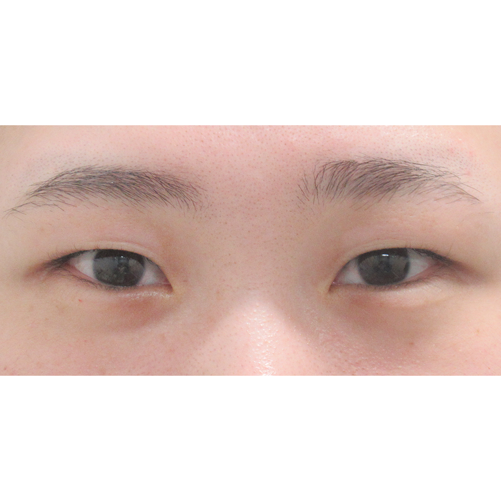 施術前正面