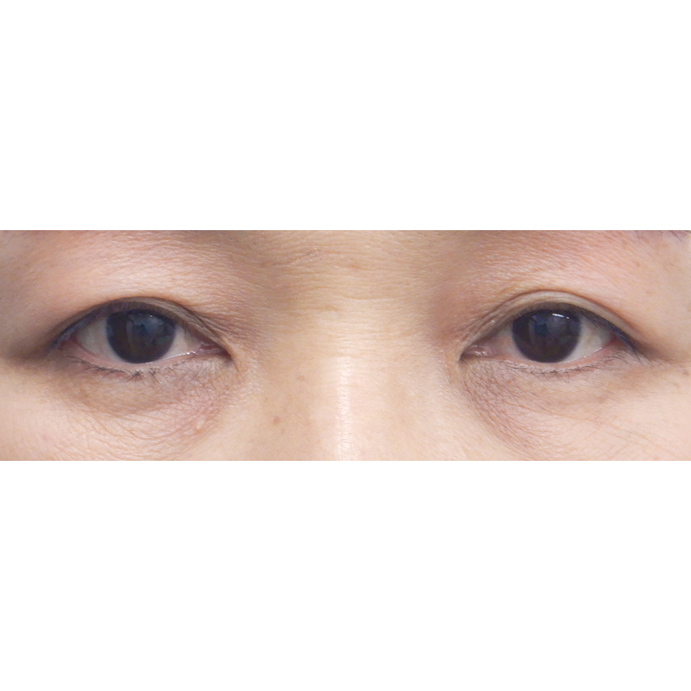 施術後正面